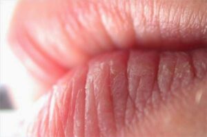 Chapped-lips-2