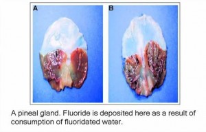 pineal-gland-decalcification